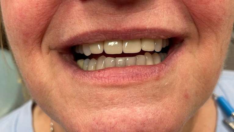 Crowns-on-top-front-teeth-After-Image