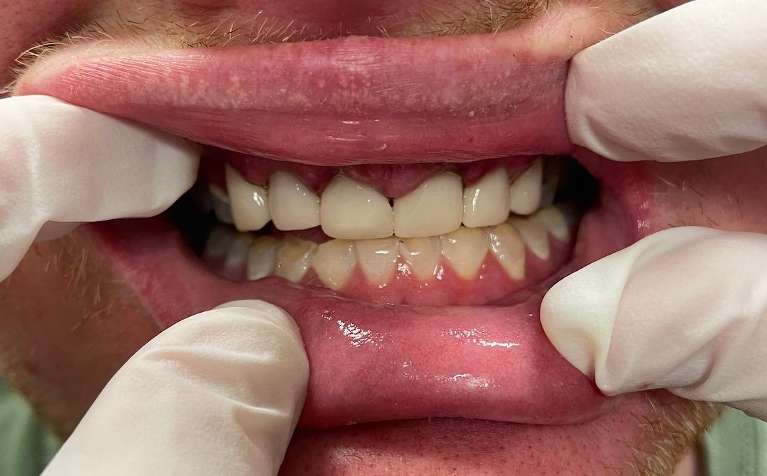 Crowns-on-top-front-teeth-After-Image