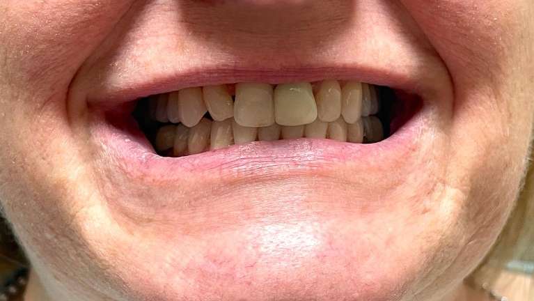 Crowns-on-top-front-teeth-Before-Image