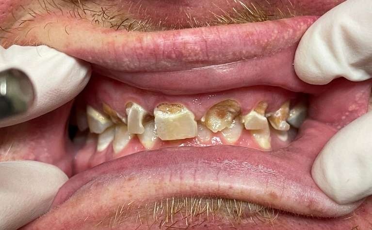 Crowns-on-top-front-teeth-Before-Image